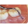 Curette Queen Of Hearts Universal